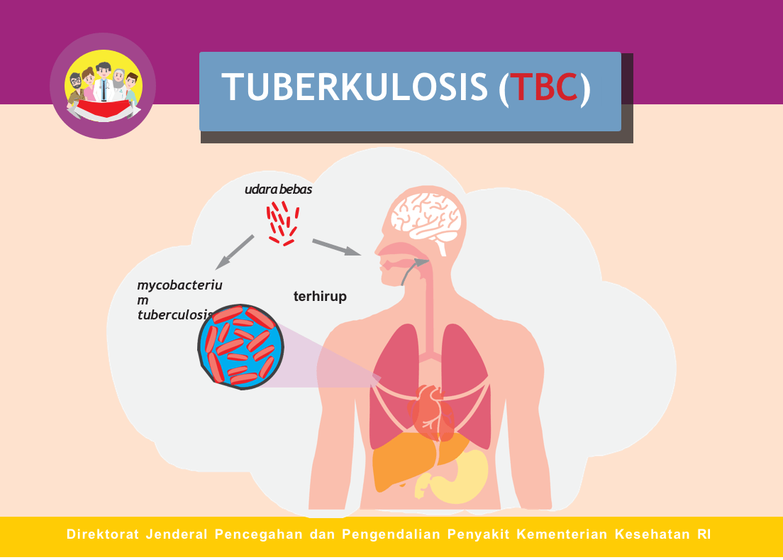 Informasi Dasar Seputar TBC